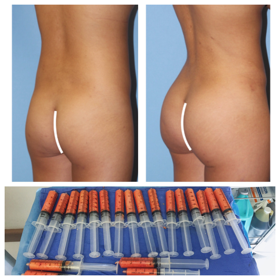 Butt Implants Beverly Hills - Butt Augmentation Surgery