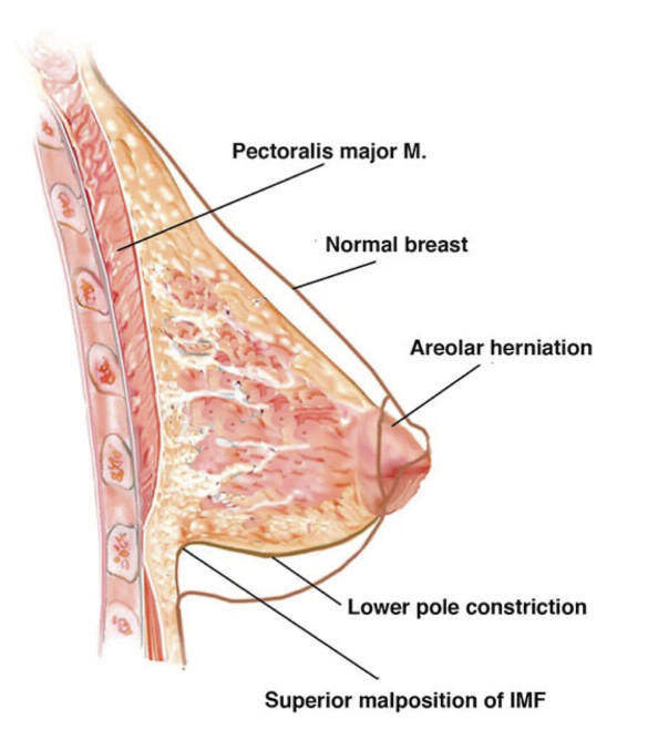 Tubular Breast Release, Tuberous Breasts, Augmentation